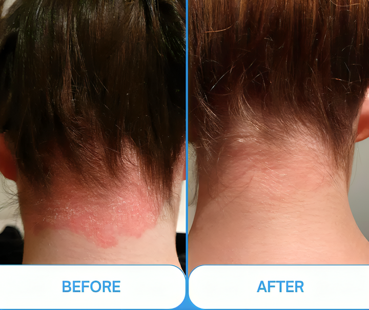 Cordless UVB lamp for at-home skin therapy, medium 5x2" area, LED screen, non-invasive treatment for psoriasis and eczema.